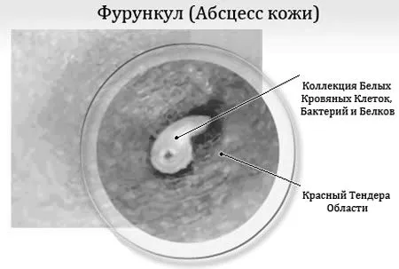 фурункул