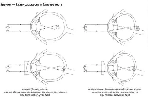 короткозорість