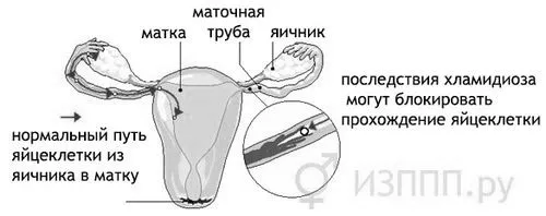 трахоматис