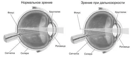 як лікувати короткозорість і далекозорість