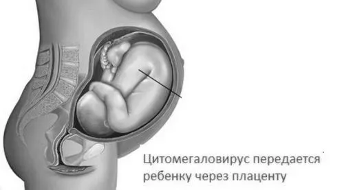 цитомегаловірус
