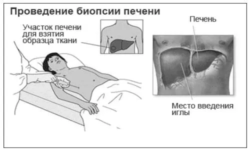 печінки