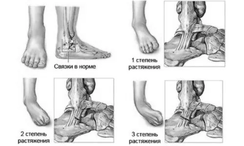 розтягнення