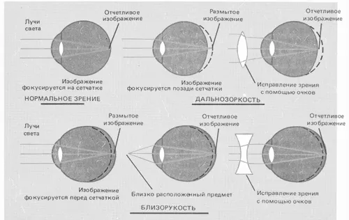 як лікувати короткозорість і далекозорість