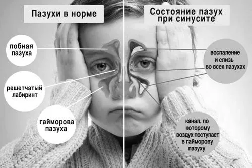 грипі