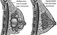 як лікувати фибро кістозна мастопатію
