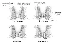 геморой