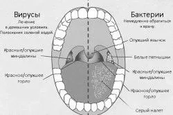 Фарингіт у дітей і його лікування як лікувати починається фарингіт