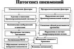 Двостороння пневмонія: причини, симптоми і лікування пневмонія