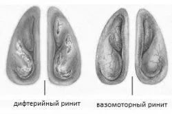 хронічний гнійний нежить