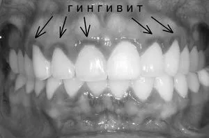 Гінгівіт у дитини: причини появи, симптоми і лікування хвороби як лікувати запалення ясен у дітей