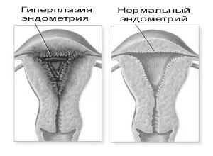 чи можна вилікувати ендометріоз без вискоблювання