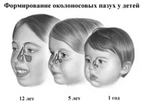 Гайморит у дітей гайморит