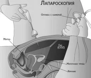 Ендометріоз яєчників: причини, симптоми, діагностика, лікування, профілактика симптоми
