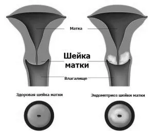 як лікувати ендометріоз шийки матки