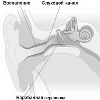 як лікувати дифузний отит