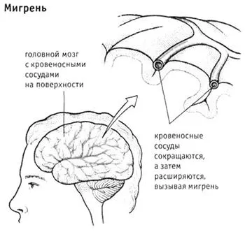 мігрень