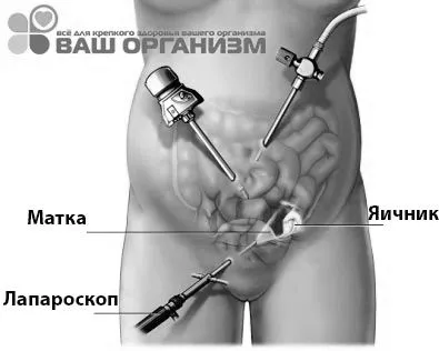 Ендометріоз матки: стадії, форми, лікування лікування