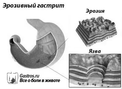 захворювань