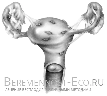 ендометріоз