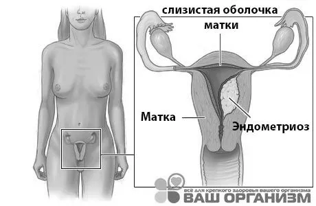 Ендометріоз матки: стадії, форми, лікування матки