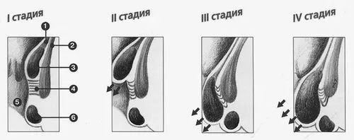 геморой