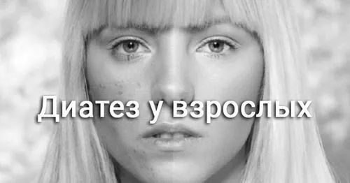 діатез