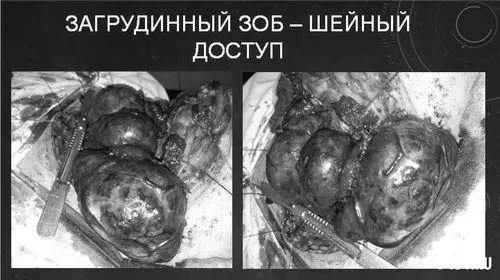 Дифузний зоб дифузний