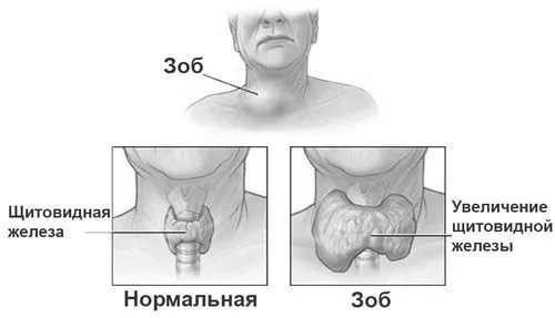 Дифузний зоб дифузний