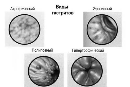 гастрит