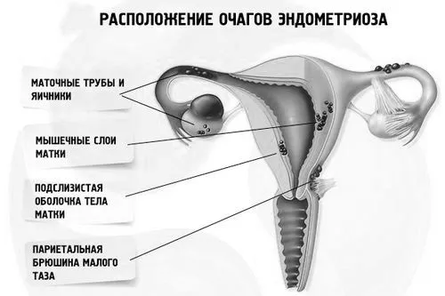 дифузний аденоміоз