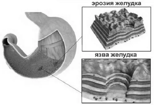 ерозія шлунка лікування
