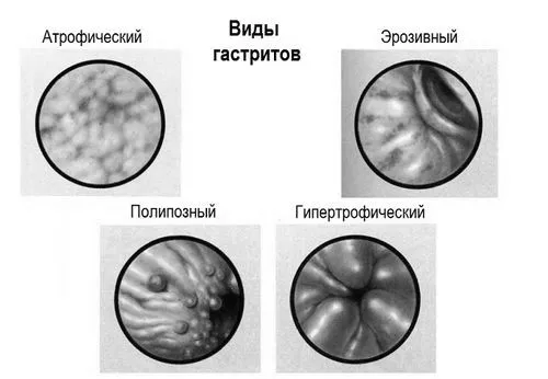 гіпертрофічний