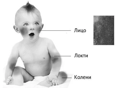лікування