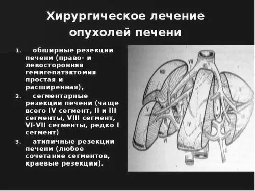 аденома