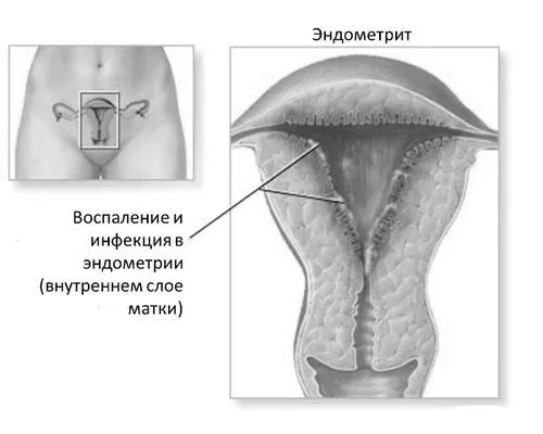 розтину