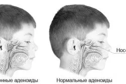 лікувати аденоїди інгалятором