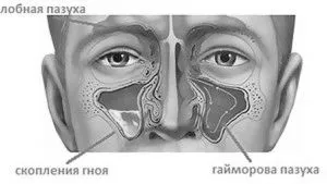 як лікувати гайморит риніт