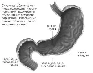 Як лікувати ерозію шлунка як лікувати ерозію шлунка народними засобами