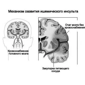як лікувати інсульт права півкуля головного мозку