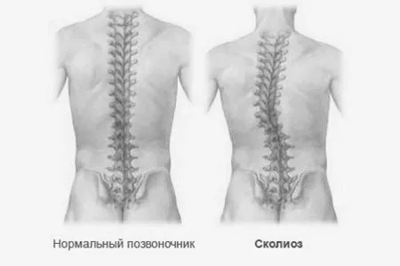 як лікувати сколіоз виправити 30 25 років домашні умови дорослі викривлення хребта