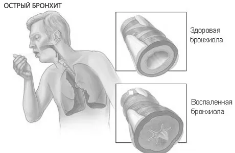 причини бронхіту