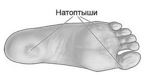 як лікувати кісткову мозоль в домашніх умовах