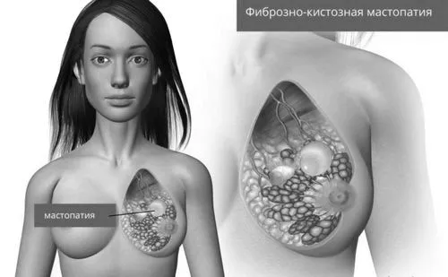 вилікувати фіброзно кістозна мастопатію