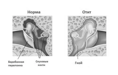 отиті