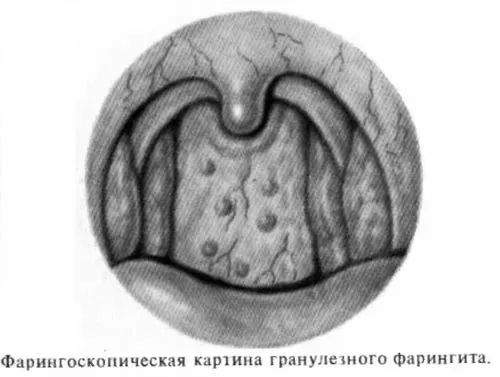 гранулезний