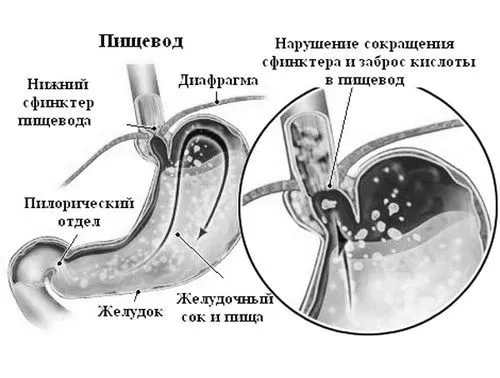 Печія у дитини печія
