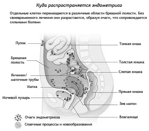 як вилікувати ендометріоз в домашніх умовах