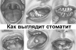 Який лікар лікує стоматит лікар