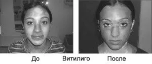 вітіліго